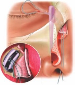 Vias Lacrimais - Cirurgia