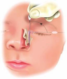 Vias Lacrimais - Cirurgia