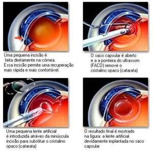 cirurgia-catarata